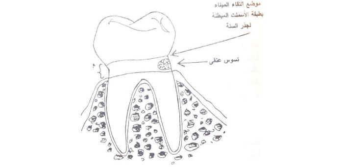 التسوس العنقي