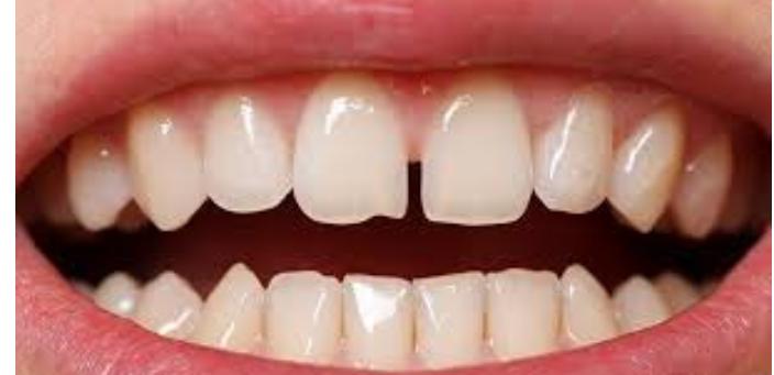 لماذا تظهر فراغات بين الاسنان الأمامية؟