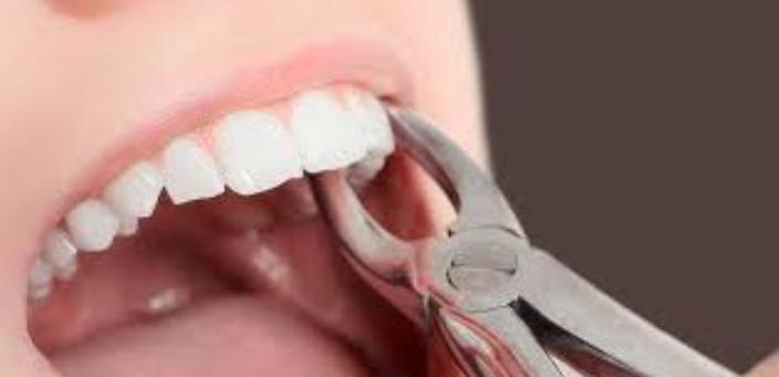 أنواع وأسباب خلع الأسنان