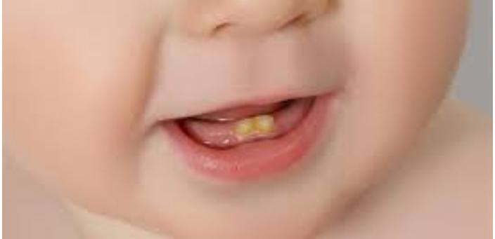 تسوس الرضاعة