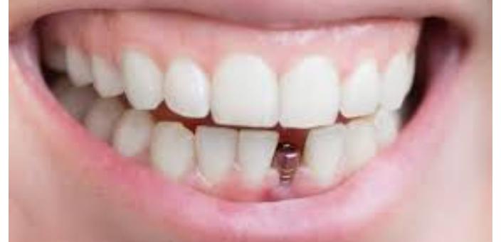 زراعة الأسنان لها فوائد وميزات