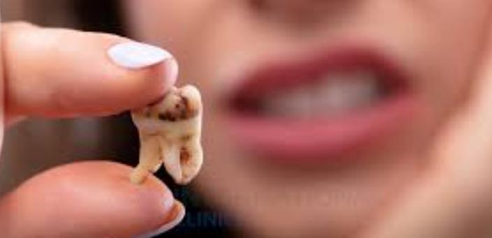 أسباب تسوس ضرس العقل